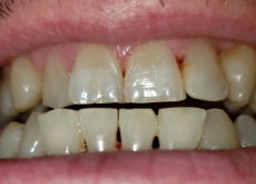 Teeth
